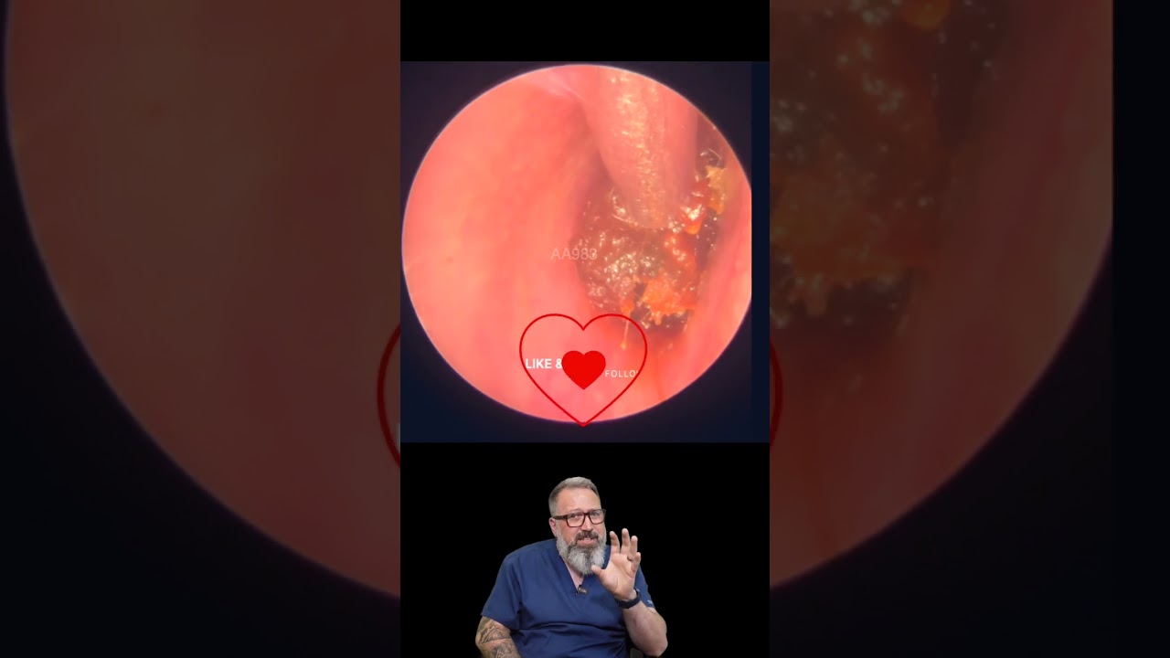 REMOVING THE DEEPEST EAR WAX PLUG - EP983