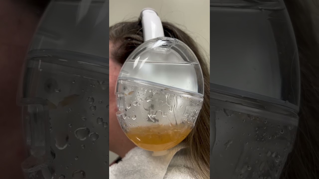 Are you tired of earwax buildup? Try a smarter solution: OtoSet