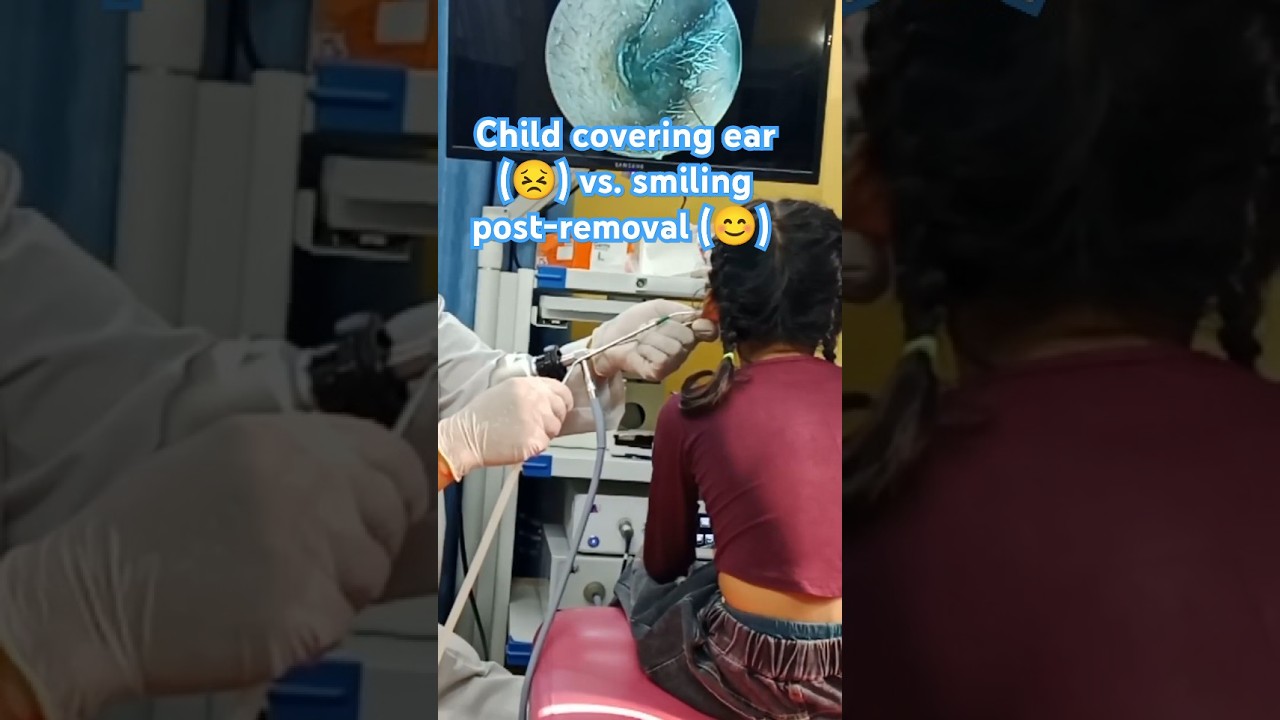 My Daughter’s *HUGE* Earwax Plug! 👶👂 (ENT Doctor’s Satisfying Removal) #EarWax #Satisfying